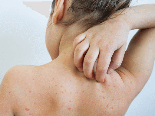 Điều trị sốt phát ban ở trẻ