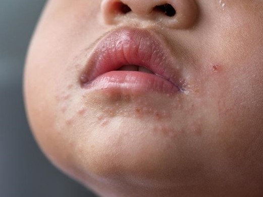 Nhận biết những dấu hiệu bị tay chân miệng ở trẻ