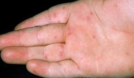 Dấu hiệu nhận biết trẻ bị tay chân miệng