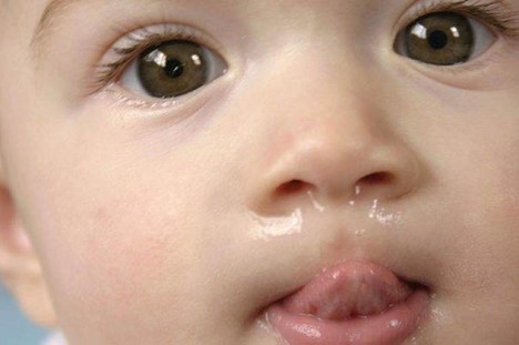 Triệu chứng sổ mũi ở trẻ sơ sinh