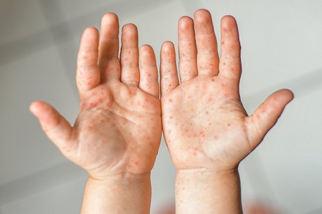 Dấu hiệu tay chân miệng ở trẻ