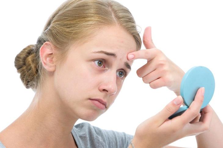 Sử dụng kem chống nắng tuổi dậy thì có gây mụn không?