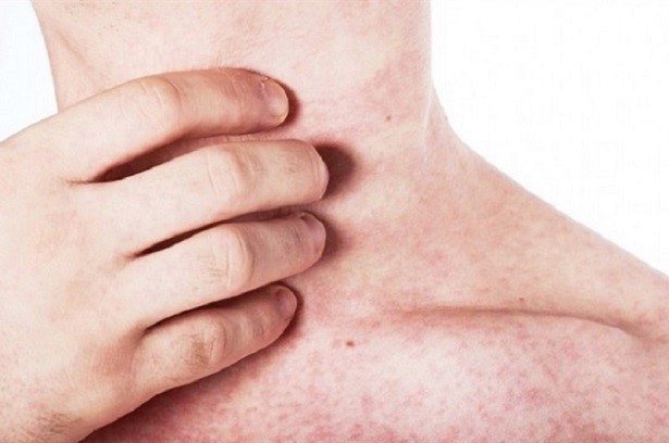 Sau Sốt Xuất Huyết: Những Hiểu Lầm Tai Hại Về Bệnh