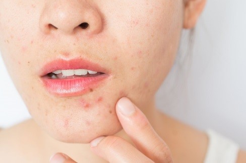 Nguyên Nhân & Cách Điều Trị Da Nhạy Cảm