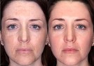 Điều Trị Da Mụn Nhạy Cảm Cùng Retinol Sao Cho Đúng?