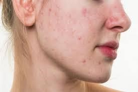 Tẩy rửa không đúng cách sẽ khiến da ửng đỏ và khô ráp đi nhiều