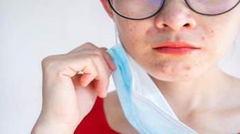 Không nên đeo khẩu trang quá lâu sẽ gây ra tình trạng bí tắc lỗ chân lông và hình thành mụn