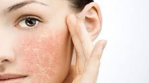 Làm Sao Để Việc Điều Trị Da Nhạy Cảm Đạt Hiệu Quả Tốt Nhất?