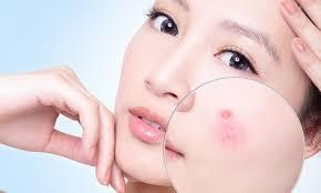 Da Yếu Dễ Nổi Mụn Cần Được Quan Tâm Chăm Sóc Như Thế Nào?