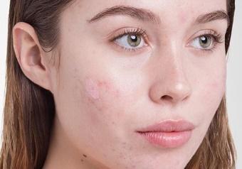 Da Mụn Có Nên Dùng Kem Dưỡng Ẩm Hada Labo Không?