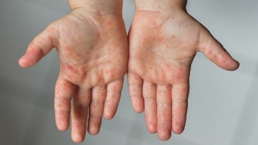 Tay chân miệng dễ bị nhầm lẫn với bệnh khác