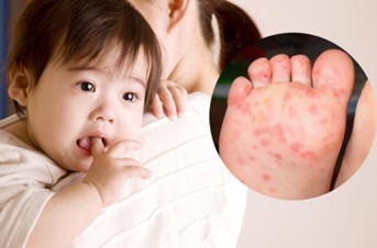Dấu hiệu bị tay chân miệng