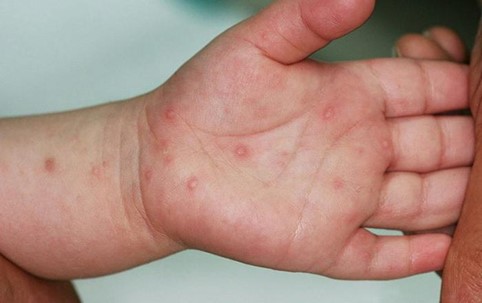 Triệu chứng tay chân miệng ở trẻ em