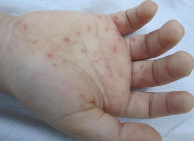 Biến Chứng Nguy Hiểm Từ Bệnh Tay Chân Miệng Trẻ Em