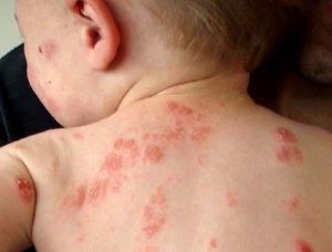Dấu hiệu nhận biết chân tay miệng ở trẻ