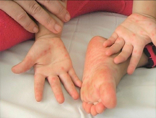 Cần chăm sóc trẻ bị bệnh tay chân miệng