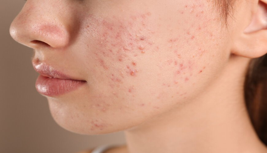 Bọt dịu lành giúp làm giảm nguy cơ tắc nghẽn lỗ chân lông và giữ cho da luôn sạch sẽ và thoáng mát