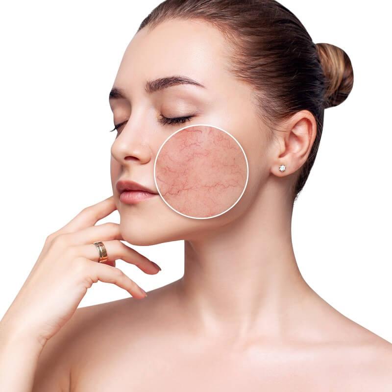 Da nhạy cảm dễ bị kích ứng bởi các thành phần hóa học mạnh và không phù hợp