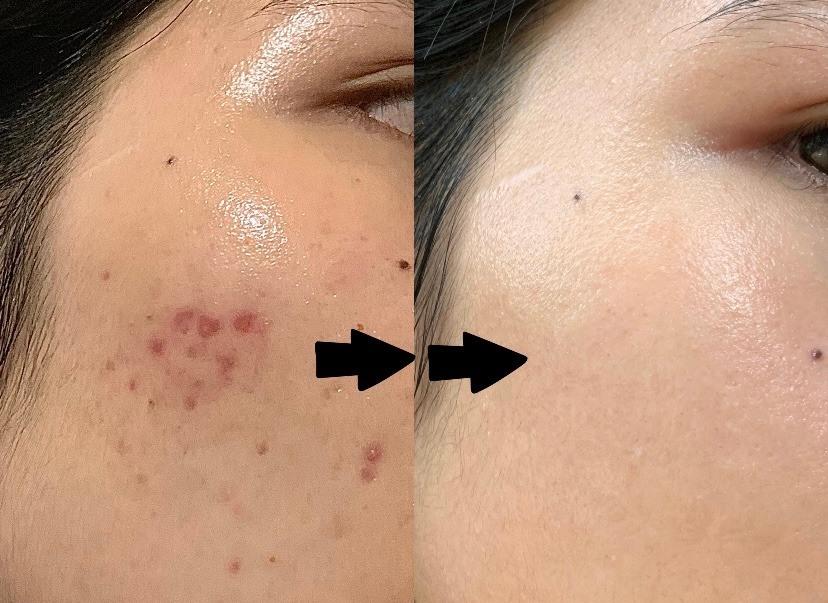 Ưu điểm vượt trội của sữa rửa mặt cho da nhạy cảm và mụn